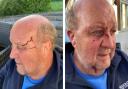 Patrick Atherton was attacked by cows while walking on a public footpath in Devon.